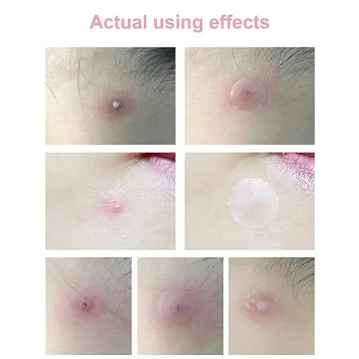 Skin Tag Acne Patch Dots Invisible Hydrocolloid Pimple Tag Remover for Face Skin, Remove All Skin Types Acne Patches for Women Skin Tag Cover Patch for Girls, Soft Pimple Cover Patch
