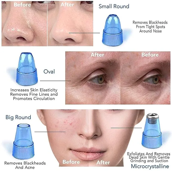 4 in 1 Multi-function Blackhead Remover and Whitehead Remover Device - Acne Pimple Pore Cleaner Vacuum Suction Tool for Men & Women Gently Draws Out Dirt & Oil from Your Skin Type